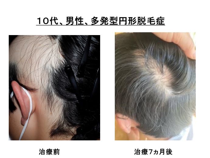 円形脱毛症　病院